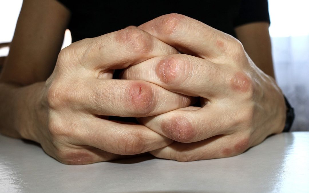 ARTRITIS PSORIÁSICA